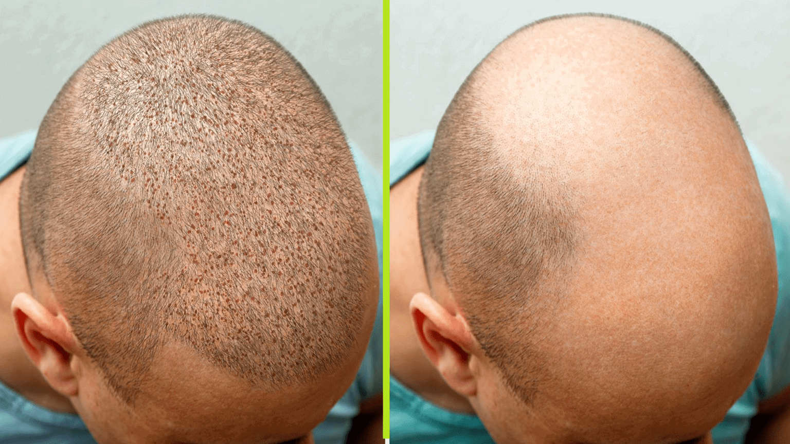 نتائج عملية زراعة الشعر