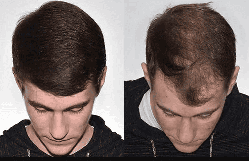 أفضل عيادة زراعة شعر في السعودية