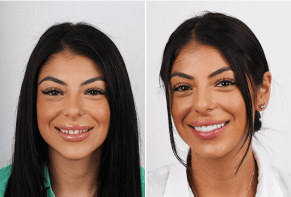 ابتسامة هوليوود