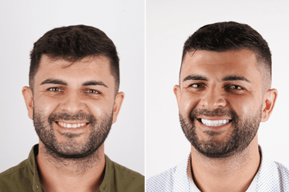 ابتسامة هوليوود