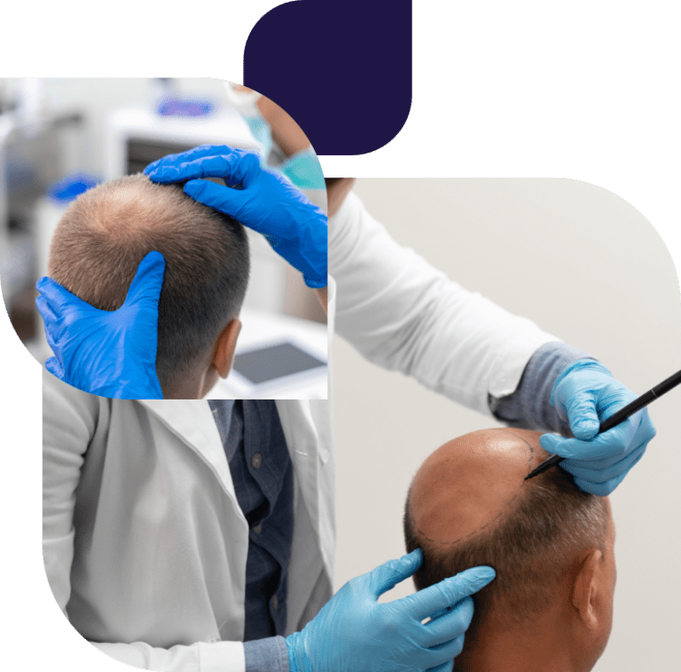 عملية زراعة الشعر