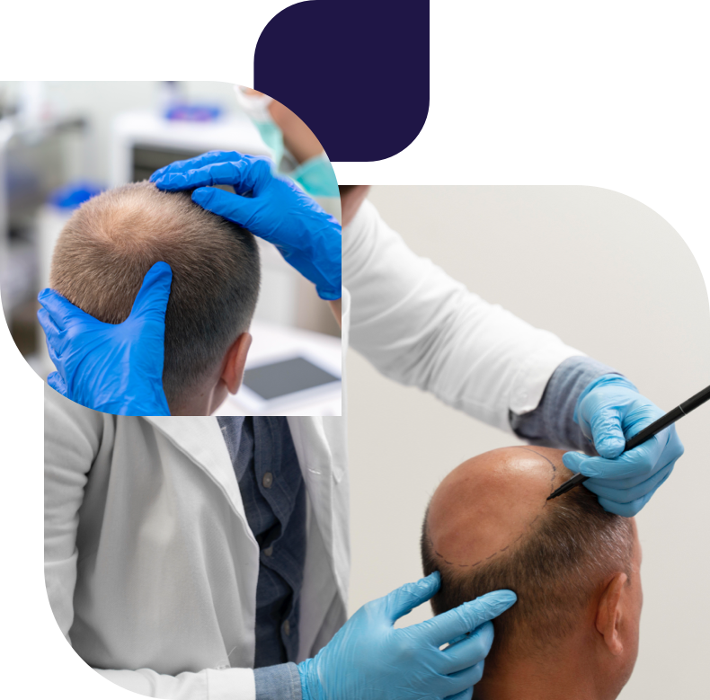 عملية زراعة الشعر
