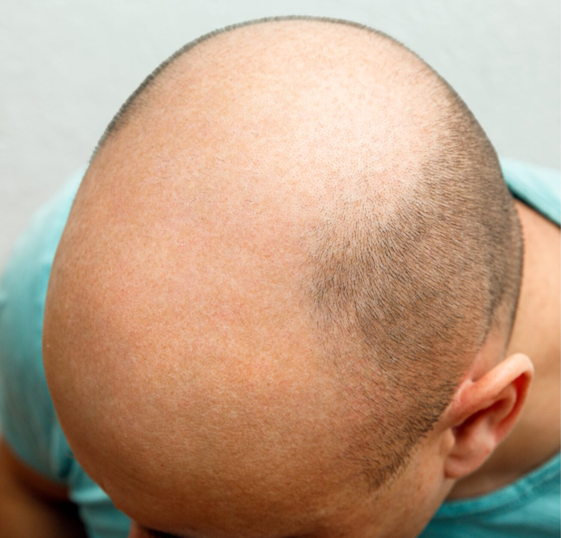 قبل عملية زراعة الشعر