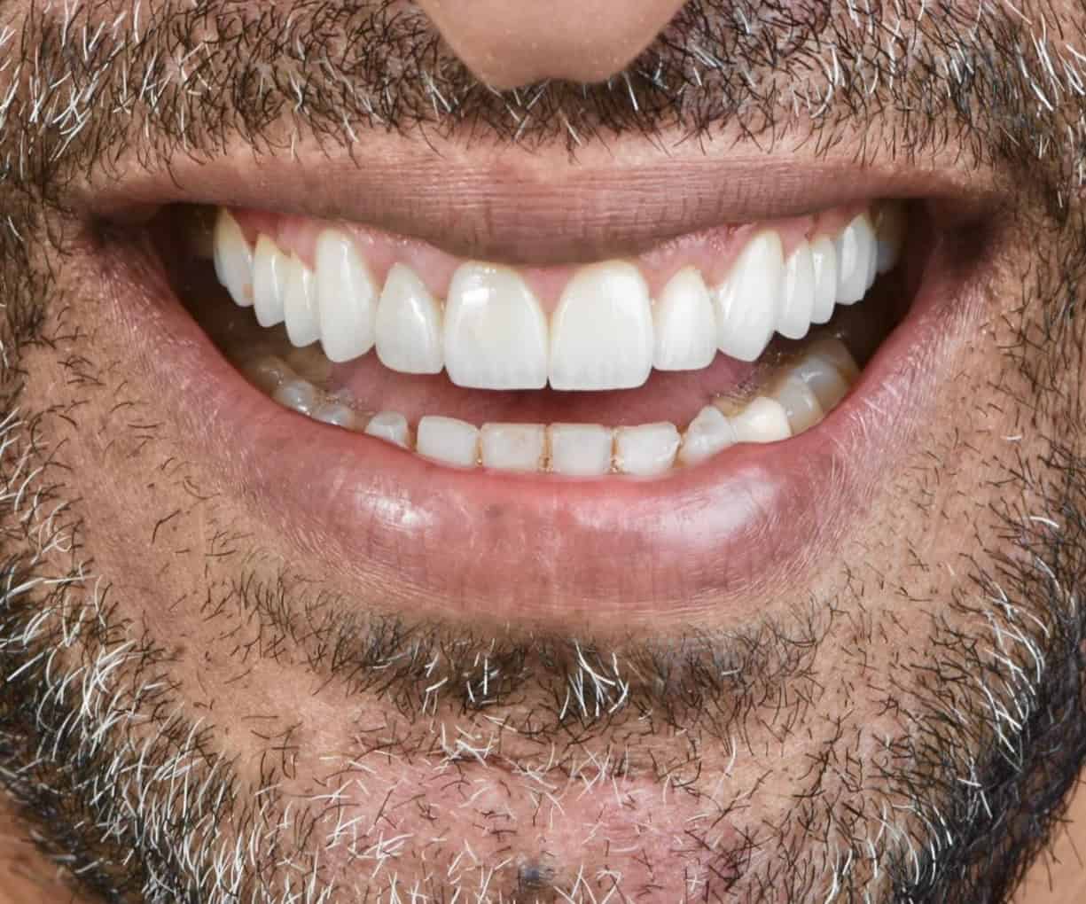 بعد-جراحة-تجميل-الاسنان