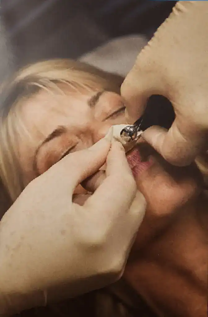 Microneedling treatment for skin rejuvenation at New Wave Stress and Pain Relief clinic.