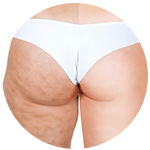 Melhora estrias e celulites