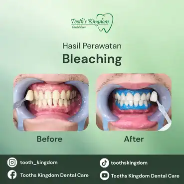 Perbandingan before after bleaching gigi di Tooth's Kingdom Jakarta, menunjukkan perubahan warna gigi yang kuning menjadi putih bersih dan cerah