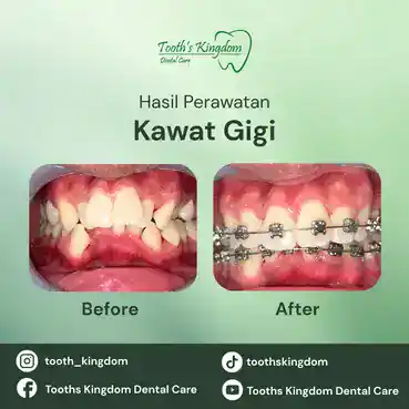 Foto perbandingan sebelum dan sesudah pasang behel di Tooth's Kingdom Dental Care Jakarta, menunjukkan transformasi gigi yang rapi dan teratur.