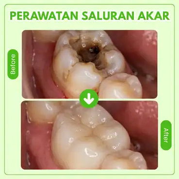 perawatan saluran akar gigi