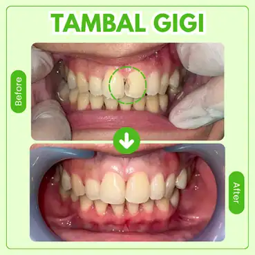 biaya tambal gigi
