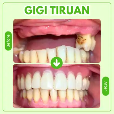gigi palsu permanen