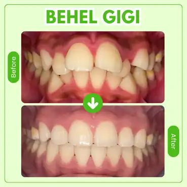 Pasang Behel Gigi