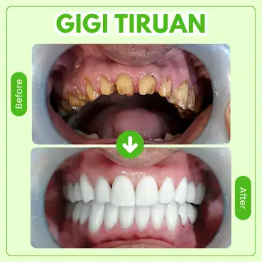Gigi Palsu