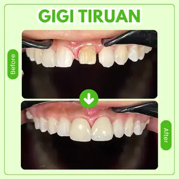 gigi tiruan
