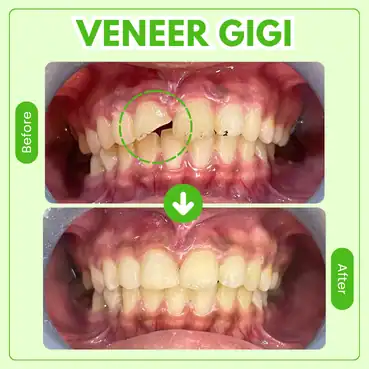 veneer gigi