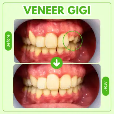 veneer gigi tooths kingdom