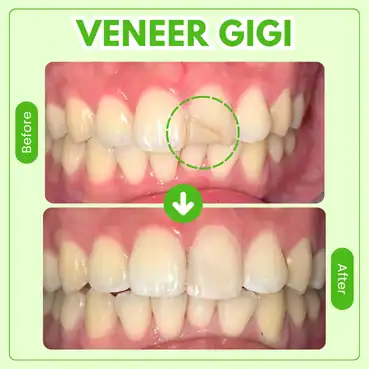 veneer gigi tooths kingdom