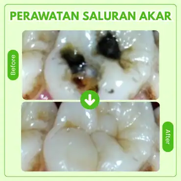 perawatan saluran akar di tooths kingdom
