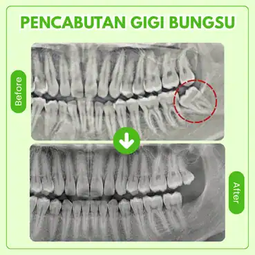 cabut gigi berapa