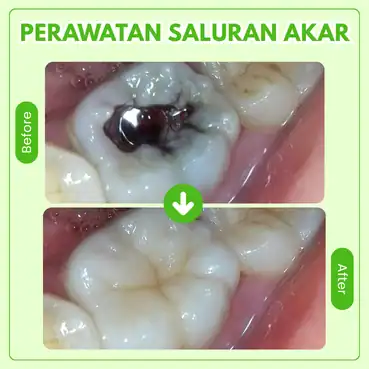 perawatan saluran akar