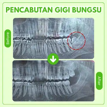 cabut gigi