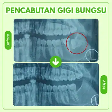 gigi bungsu