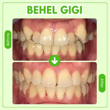 harga behel gigi tooths kingdom
