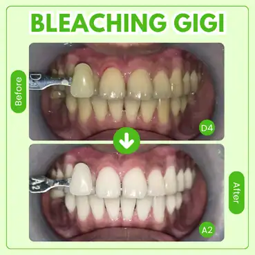 biaya bleaching gigi di tooths kingdom