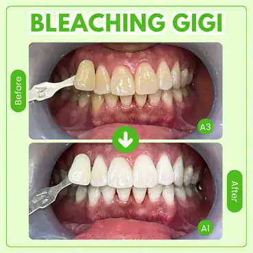 memutih bleaching gigi di tooths kingdom