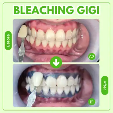 harga bleaching gigi di tooths kingdom