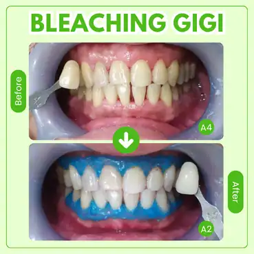 bleaching gigi