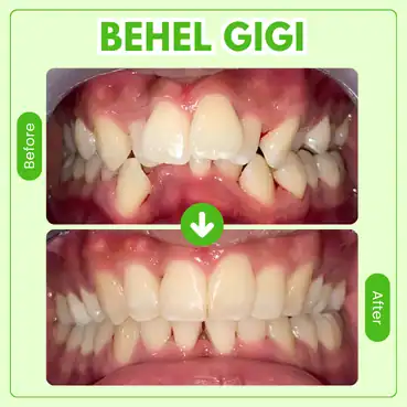 behel gigi