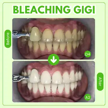bleaching gigi