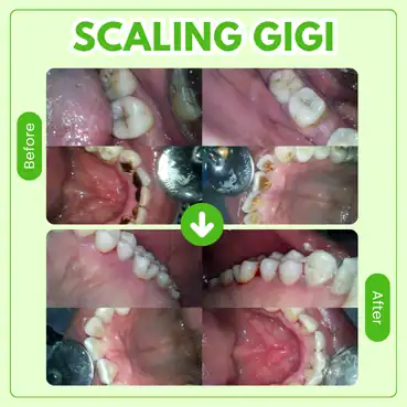 hasil perawatanscaling gigi tooths kingdom