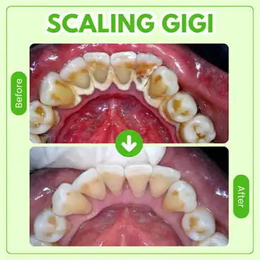 perawatan scaling gigi tooths kingdom