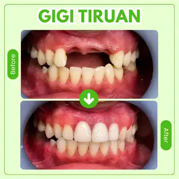 pasang gigi palsu
