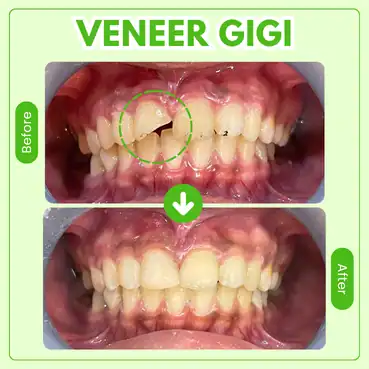 hasil veneer gigi