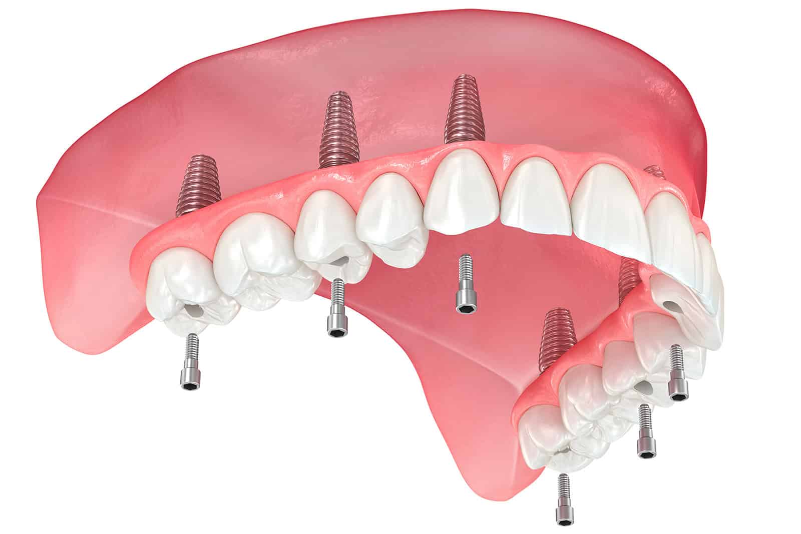 Maxillary prosthesis with gum All on 6 system supported by implants. Dental 3D illustration