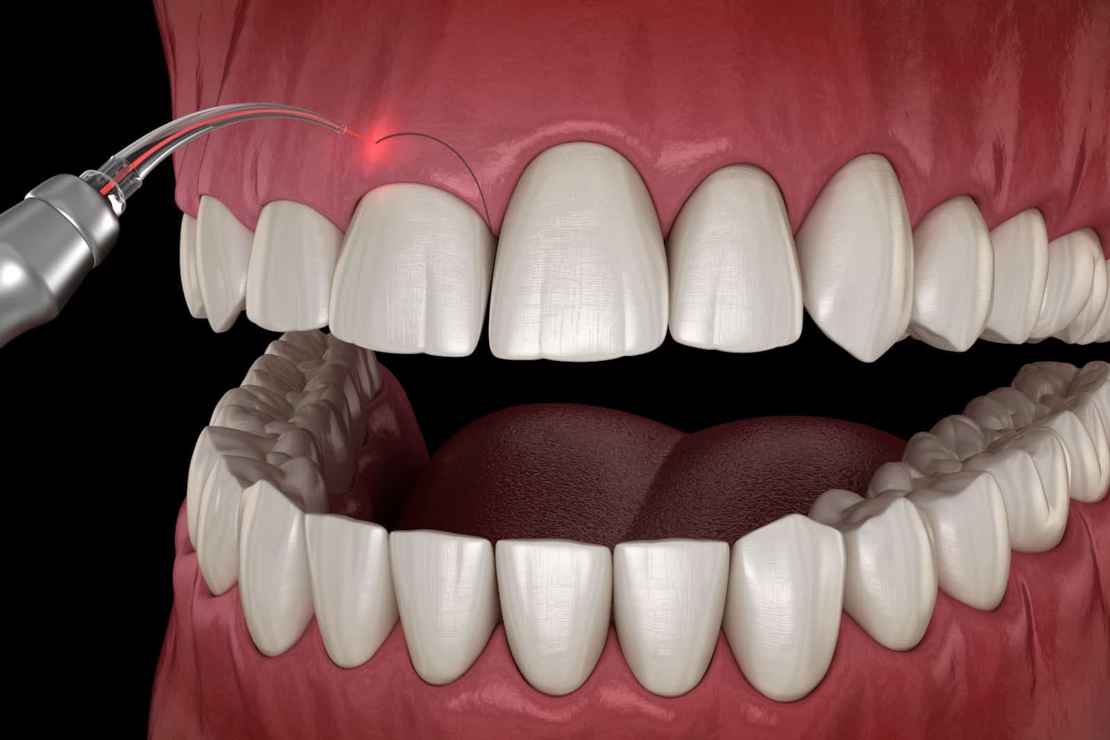 3D model of gingivectomy procedure