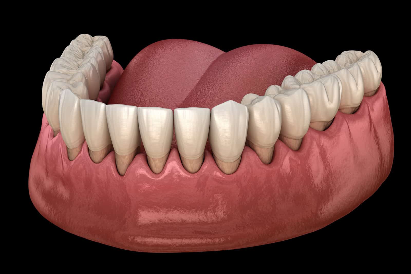 A 3D model of gum recession