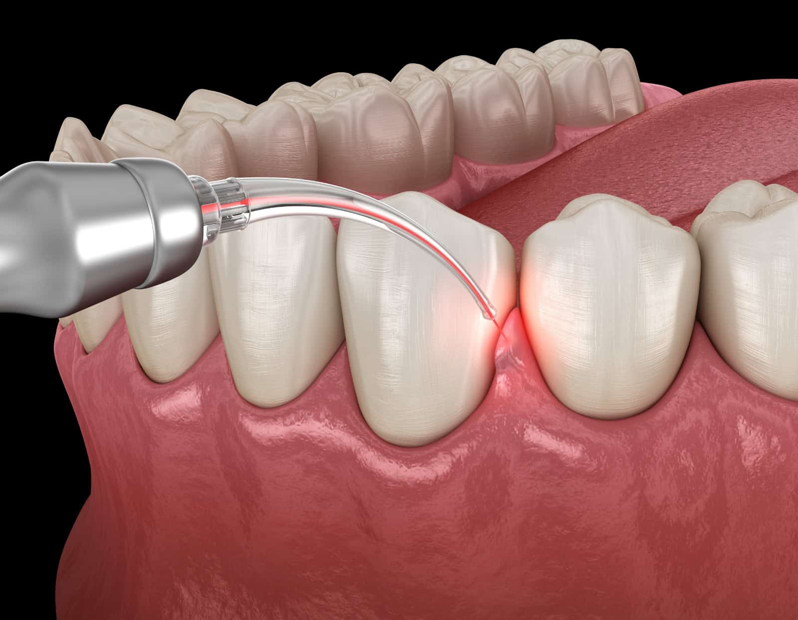 Gum correction surgery with laser. Medically accurate tooth 3D illustration