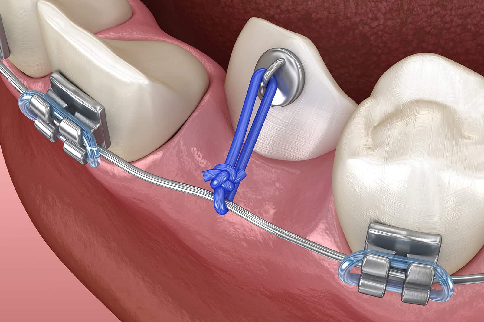 Impacted Cuspid and elastic for correction. Medically accurate dental 3D illustration