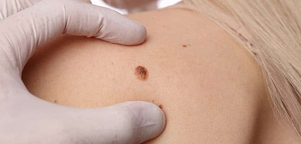 Melanoma-cutaneo