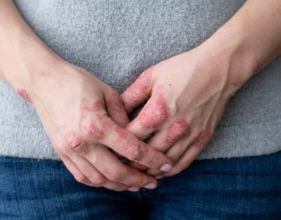 Dermatologo specializzato in psoriasi