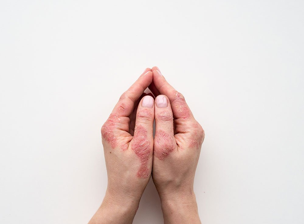 Qual è la differenza tra dermatite seborroica e psoriasi?