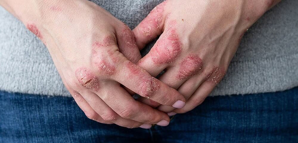 Dermatologo per dermatite seborroica