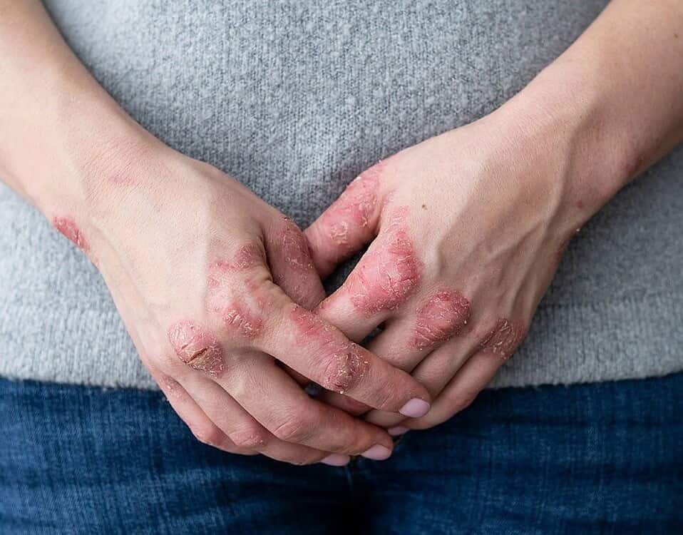 Dermatologo per dermatite seborroica