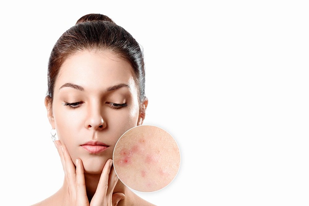 Dermatologo specializzato in acne