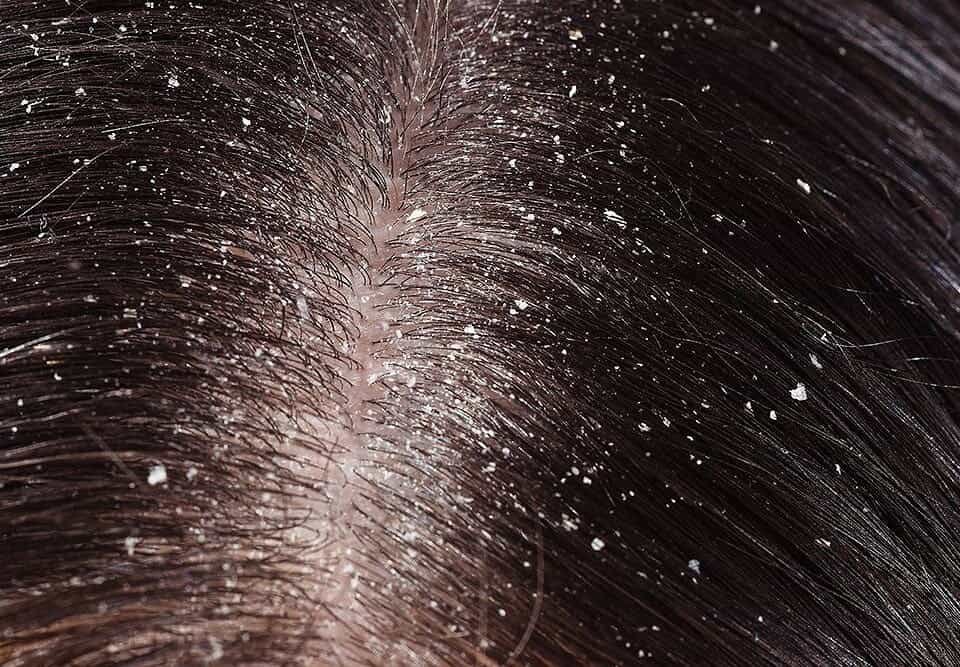 Dermatologo per seborrea