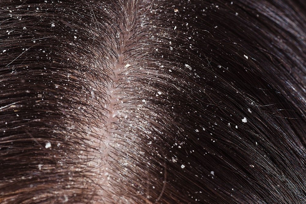 Dermatologo per seborrea